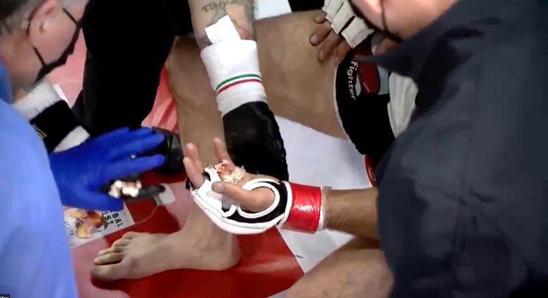 MMA fighter’s finger temporarily disappears during CFFC fight
