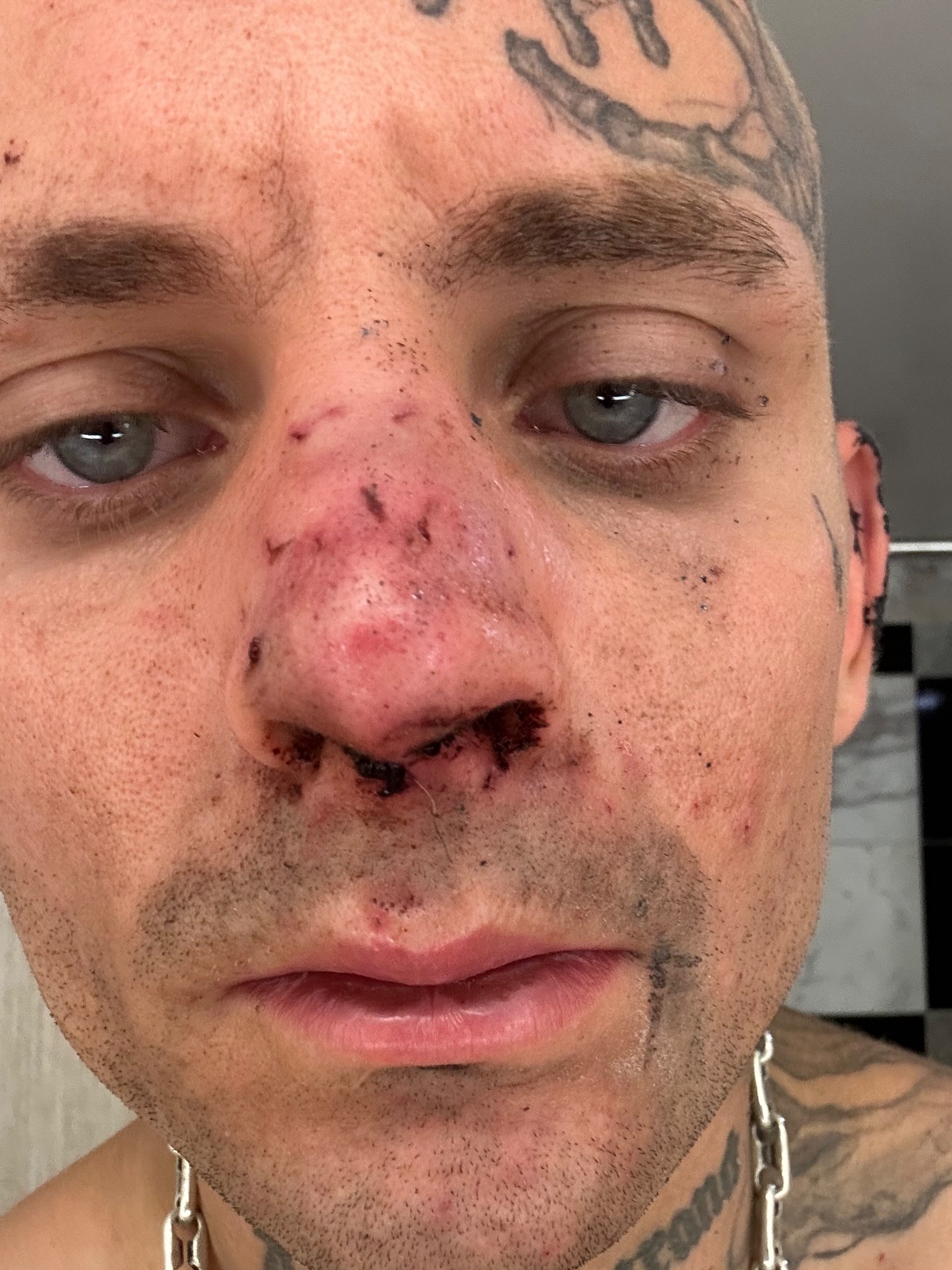 Injury update on Darby Allin following AEW Anarchy in the Arena match